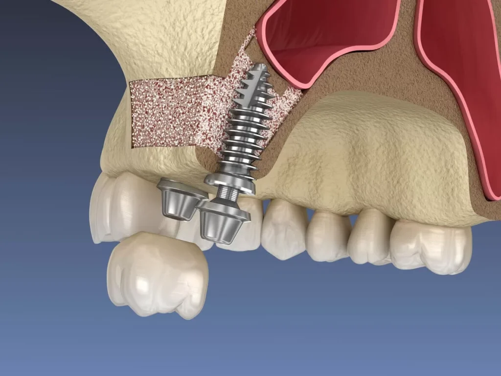 sinus-lift-surgery