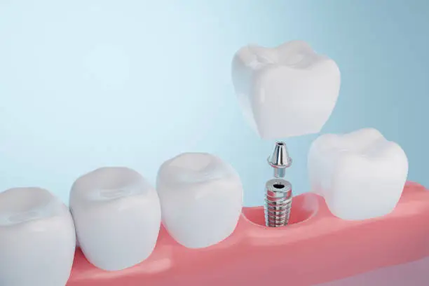 Dental implant being placed in a patient's jaw during surgery