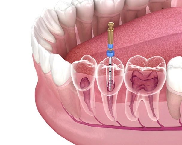 Root canal procedure overview including treatment procedures benefits and cost information