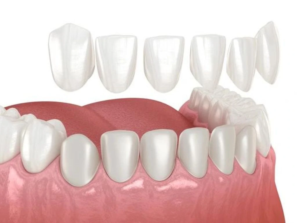 Step by step process of getting dental veneers for a confident smile