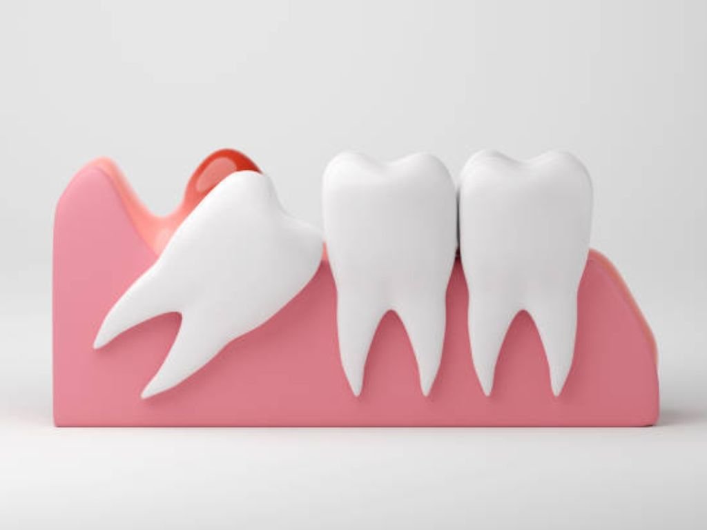 Wisdom tooth extraction image with dental tools and patient